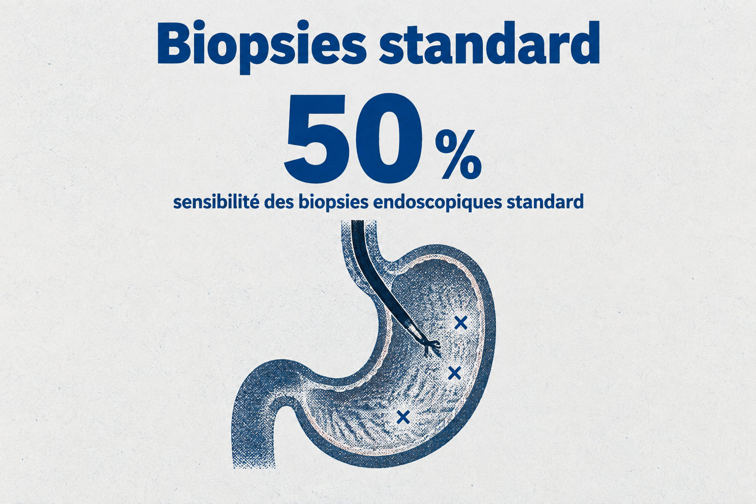 Les biopsies endoscopiques standard ont une sensibilité d’environ 50 % dans la forme linitique.