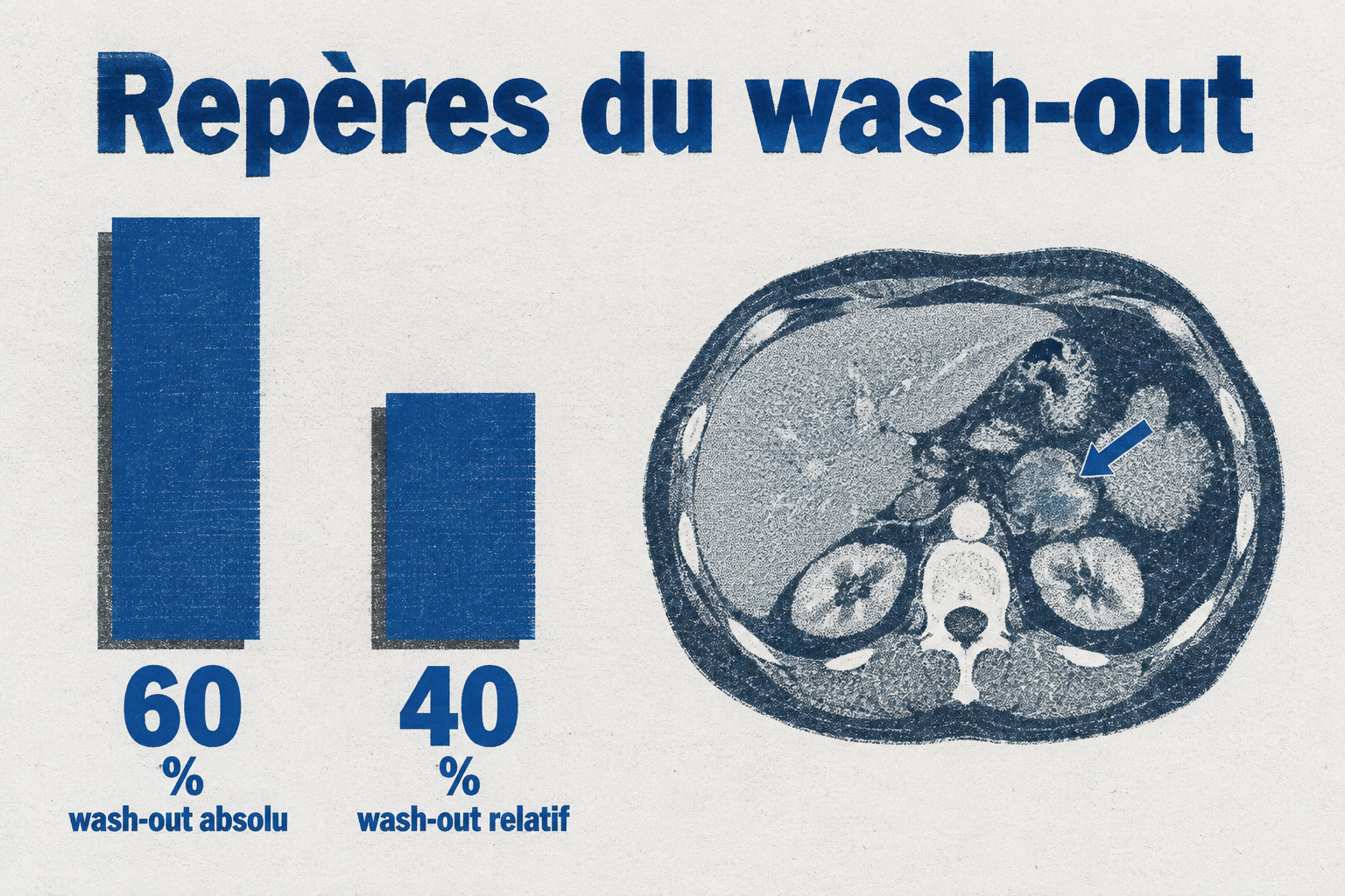 Les seuils de wash-out orientant vers un adénome sont de 60 % pour l’absolu et de 40 % pour le relatif, sans prouver la bénignité.